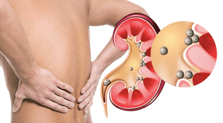 Cálculos Renales (Litiasis Urinaria)