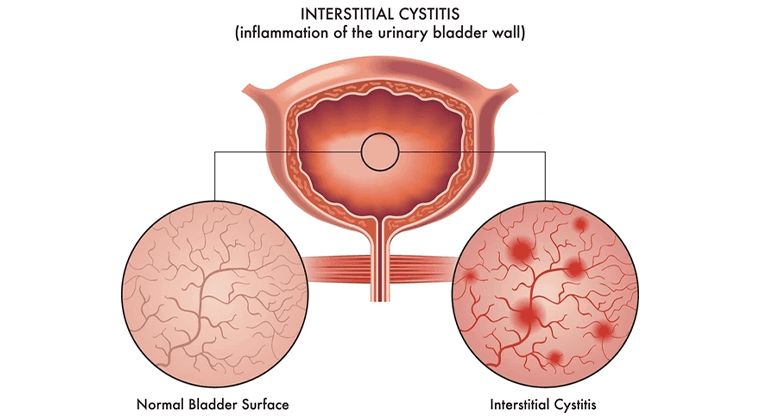Cistitis Intersticial (Síndrome de Vejiga Dolorosa)
