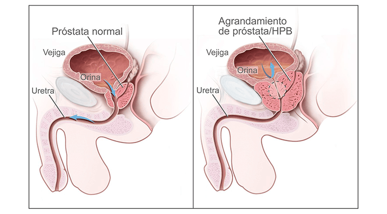 Hiperplasia Prostática Benigna (HPB)