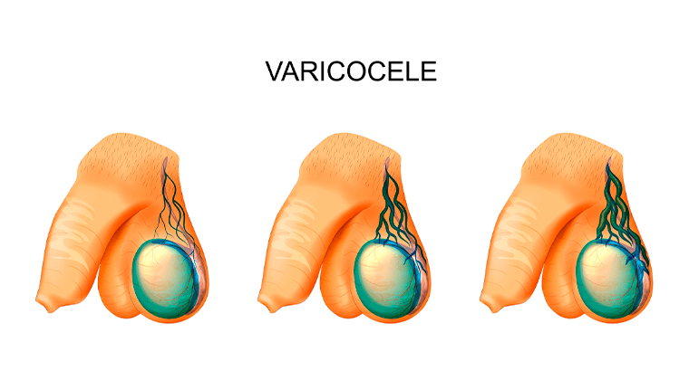 Varicocele