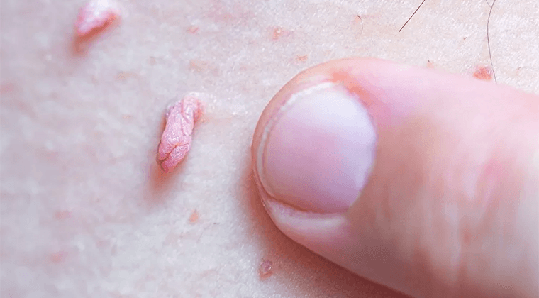 Verrugas Genitales (Condilomas)