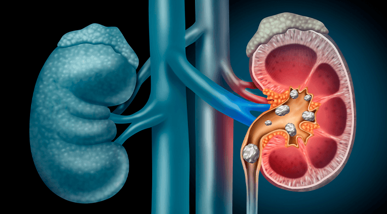 Tratamiento de Cálculos Renales (Litiasis)