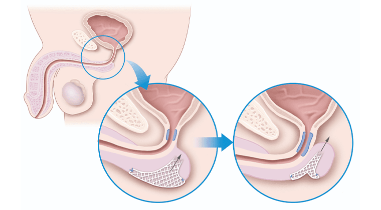 Tratamiento de la Incontinencia Urinaria