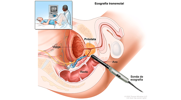 Tratamientos de Próstata