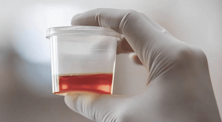 Hematuria (Sangre en la Orina)