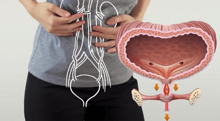 Incontinencia Urinaria (Pérdida Involuntaria de Orina)