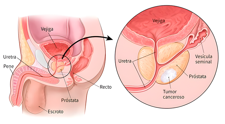 Cáncer de Próstata